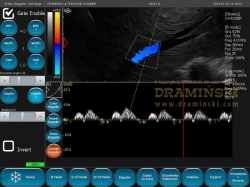 DRAMINSKI OPUS D mobilní ultrazvuk pro lékaře vyžadující mobilní zařízení s velmi kvalitním zobrazením
