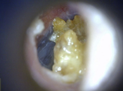 Digitální otoskop EarScope Basic Dinolite